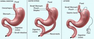 bariatric surgery